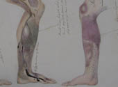 Anatomical drawings of the effects of scurvy: Dr Mahon, surgeon-superintendent on the Barrosa, 1841-42 (Ref: ADM 101/7/8)